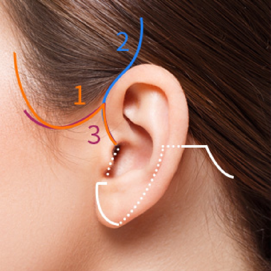 The Plan Plastic Surgery incision
