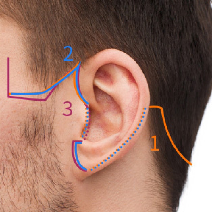 The Plan Plastic Surgery incision