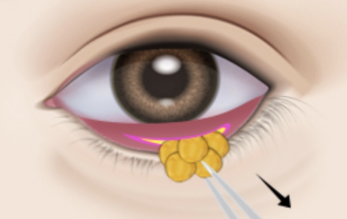 6 Step下眼瞼手術で若々しく美しい目元を作る