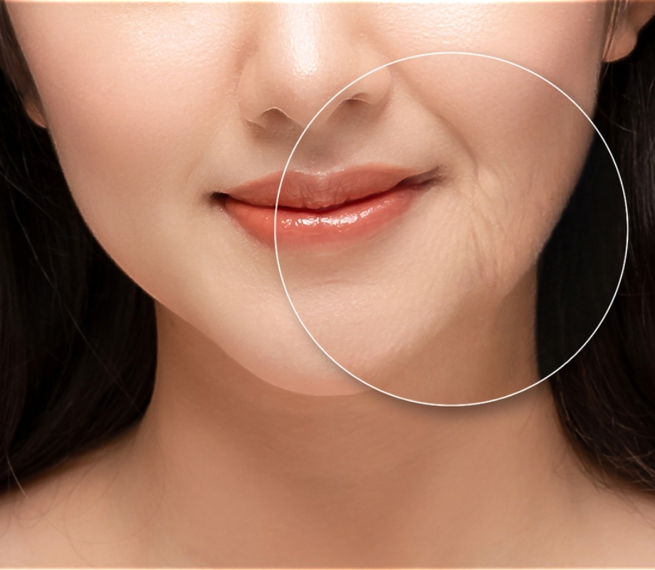 Mini face lift