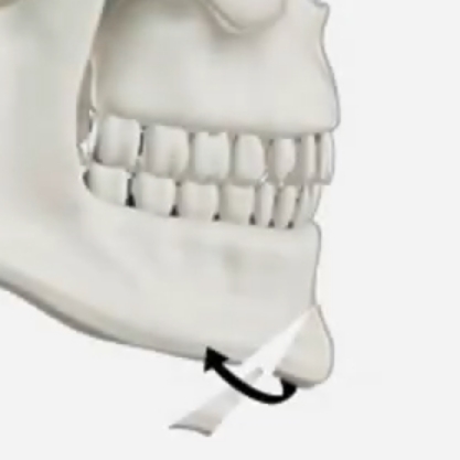 chin tip Protruding Chin step 2