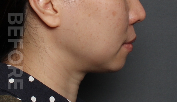chin tip before