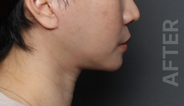 chin tip after