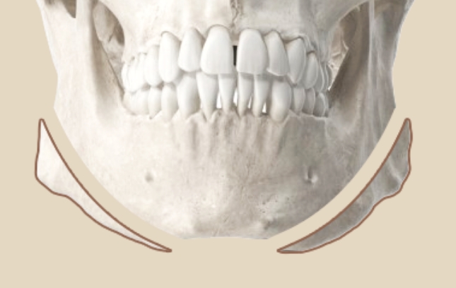 long jawline surgery step 2