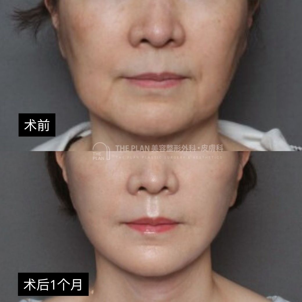 上下拼图展示了术前与术后1个月中下半脸及颈部的细节变化。术后木偶纹消失,下颌线线条变得清晰紧致。