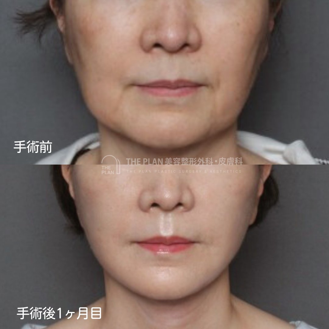 フェイスリフトおよび首のリフトを行った50代女性の口元・顎下の拡大写真。手術前(上)と術後1ヶ月(下)を比較し、口横のもたつきや首のシワが解消された様子