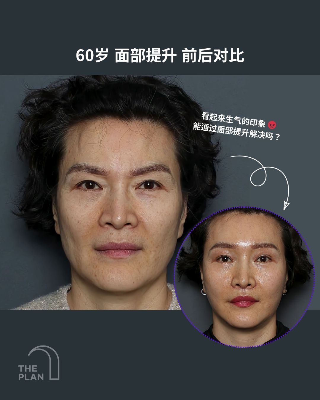 60岁女性面部提升手术前后对比案例图。图片配文“看起来生气的印象，能通过面部提升解决吗？”，展示了术前较为严肃松弛的面容与术后（圆形小图）皮肤紧致、表情柔和的年轻化效果对比。含有THE PLAN美容整形外科Logo。
