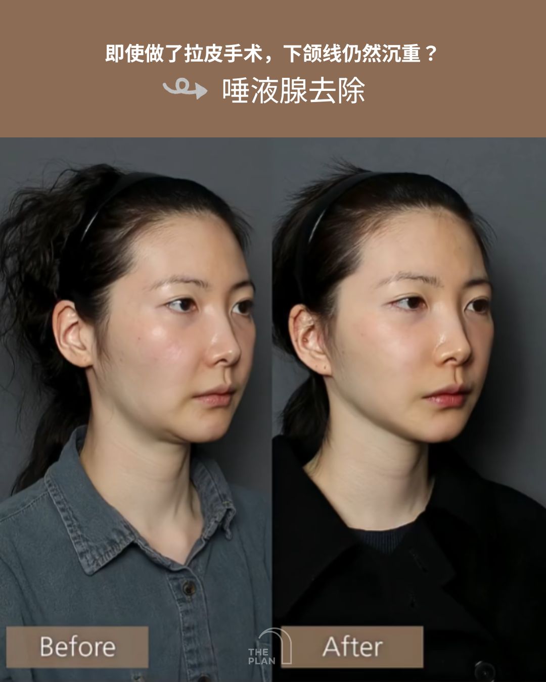一张展示拉皮手术结合唾液腺去除（缩小）效果的面部对比图。左侧为术前（Before），右侧为术后（After）。图片上方配有中文文案：“即使做了拉皮手术，下颌线仍显沉重？#唾液腺去除”。术后图像显示，原本略显下垂和厚重的下颌线条变得更加紧致，整体轮廓更加清晰且年轻化。