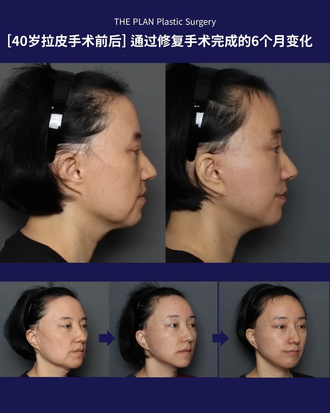 [40岁拉皮手术前后] 通过修复手术完成的6个月变化，面颊下垂和下颌线的戏剧性变化（额头提升+脂肪移植） 概要：展示了一位40多岁女性接受拉皮修复手术、额头提升及脂肪移植前后的综合对比照片。 详细内容： 上部分：侧位对比（术前 vs 术后6个月），重点展示下颌缘线条从松弛到紧致的转变。 下部分：展示了从手术前、术后1个月到术后6个月的斜侧位恢复过程，体现了面部整体轮廓的逐渐提升。 视觉变化：术前可见明显的颊部下垂和双下巴，术后6个月面部轮廓明显上提，皮肤更加平滑紧致，整体形象更显年轻。 文本信息：包含“THE PLAN Plastic Surgery”、“40岁拉皮手术前后”、“手术前”、“1个月后”、“6个月后”等说明文字。
