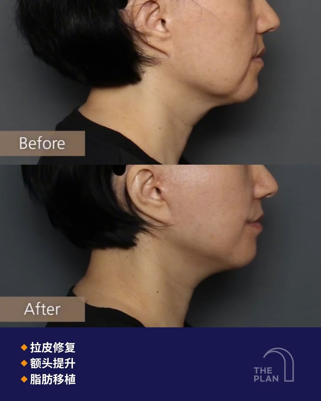 拉皮修复手术、额头提升及脂肪移植的侧位细节对比图 (Before & After) 概要:重点展示中下面部及颈部线条在手术前后的局部对比。 详细内容: 上方(Before):显示术前面颊组织松弛下垂,下颌线模糊,且伴有明显的颈部皮肤松弛。 下方(After):显示术后6个月,下颌线变得清晰锐利,面部下缘组织紧致,脂肪移植使面部充盈感更自然。 手术项目:图片标注了主要手术项为拉皮修复、额头提升、脂肪移植。 品牌信息:右下角带有“THE PLAN”诊所标志。