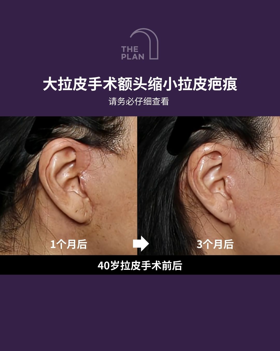 THE PLAN美容整形外科拉皮手术疤痕恢复高清对比图。左侧显示术后1个月时切口处略带泛红；右侧显示术后3个月时疤痕已明显变淡，自然隐藏于耳际轮廓中。展示了40岁女性进行大拉皮及额头缩小手术后的真实恢复效果。