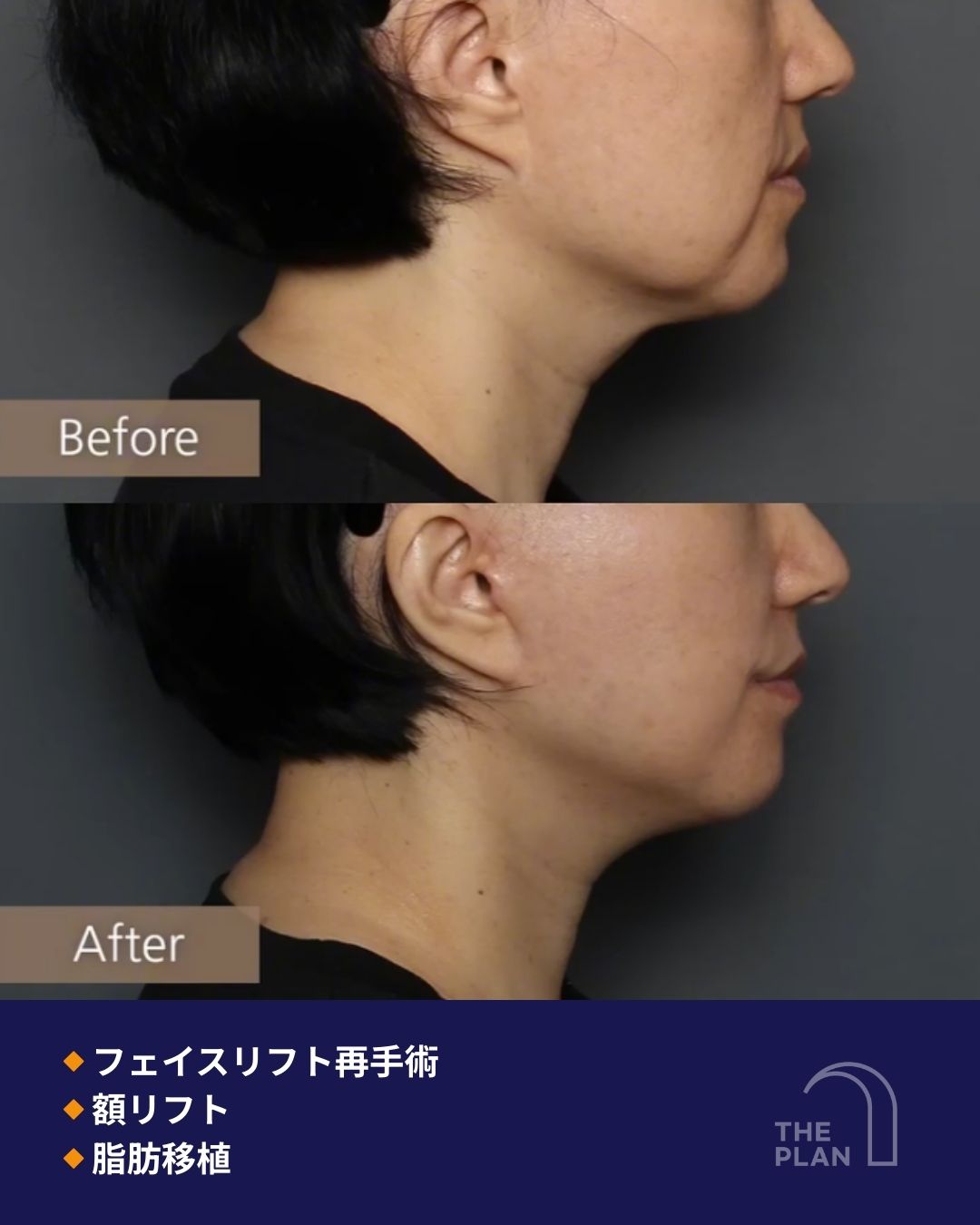 フェイスリフト再手術・額リフト・脂肪移植の横顔Before/After比較 概要: 顎ラインと首元の変化に焦点を当てた、横顔のクローズアップ比較画像。 詳細: 上に「Before」、下に「After(6ヶ月後)」を配置。 変化のポイント: 顎下のたるみが消失し、顎から耳にかけてのフェイスラインが明確に改善されている。肌の凹凸が脂肪移植によって滑らかに整い、全体的にリフトアップされた印象を強調している。 テキスト情報: 「Before」「After」「◆フェイスリフト再手術」「◆額リフト」「◆脂肪移植」「THE PLAN」のロゴ。