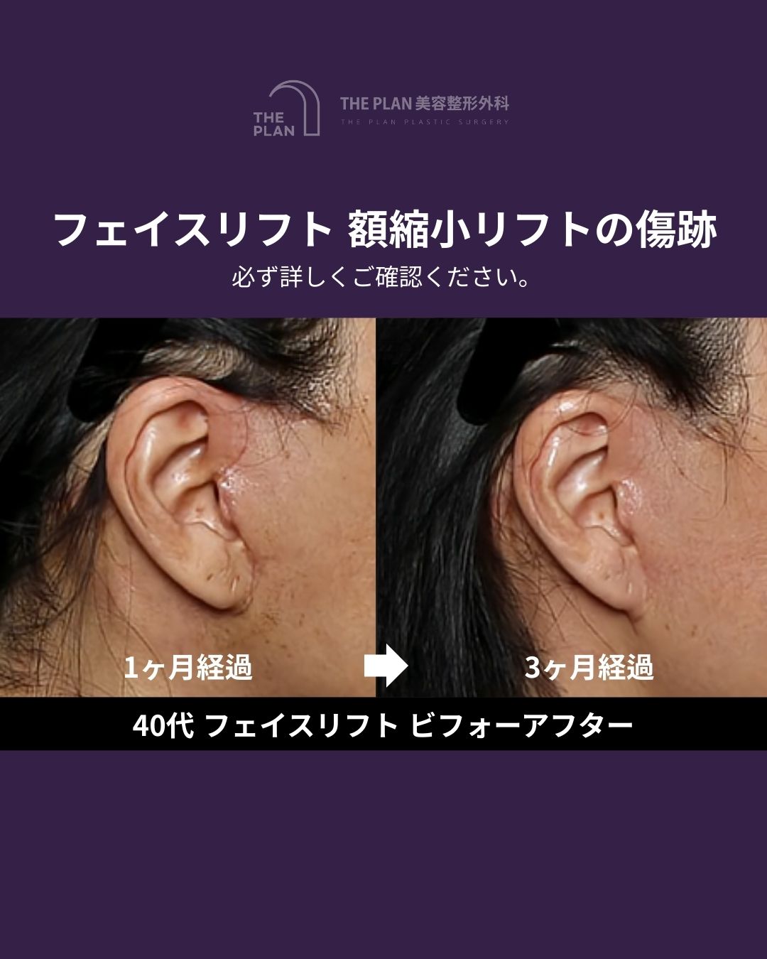 THE PLAN美容整形外科によるフェイスリフト・額縮小リフトの傷跡比較画像。左側の術後1ヶ月の赤みのある状態に対し、右側の術後3ヶ月では傷跡が薄くなり、耳のラインに馴染んで目立たなくなっている様子がわかります。40代女性のビフォーアフター。