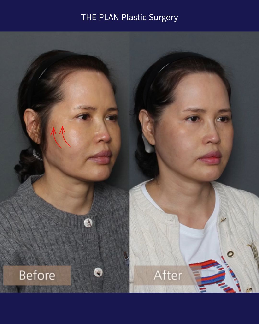 THE PLAN Plastic Surgeryの施術前と施術後の比較写真(斜め45度からのアングル)。左側が「Before」、右側が「After」です。Beforeの写真の右頬部分には、たるみを引き上げる方向を示す2本の赤い上向き矢印が描かれています。Afterでは頬から顎にかけてのラインが引き上がっている様子が確認できます。
