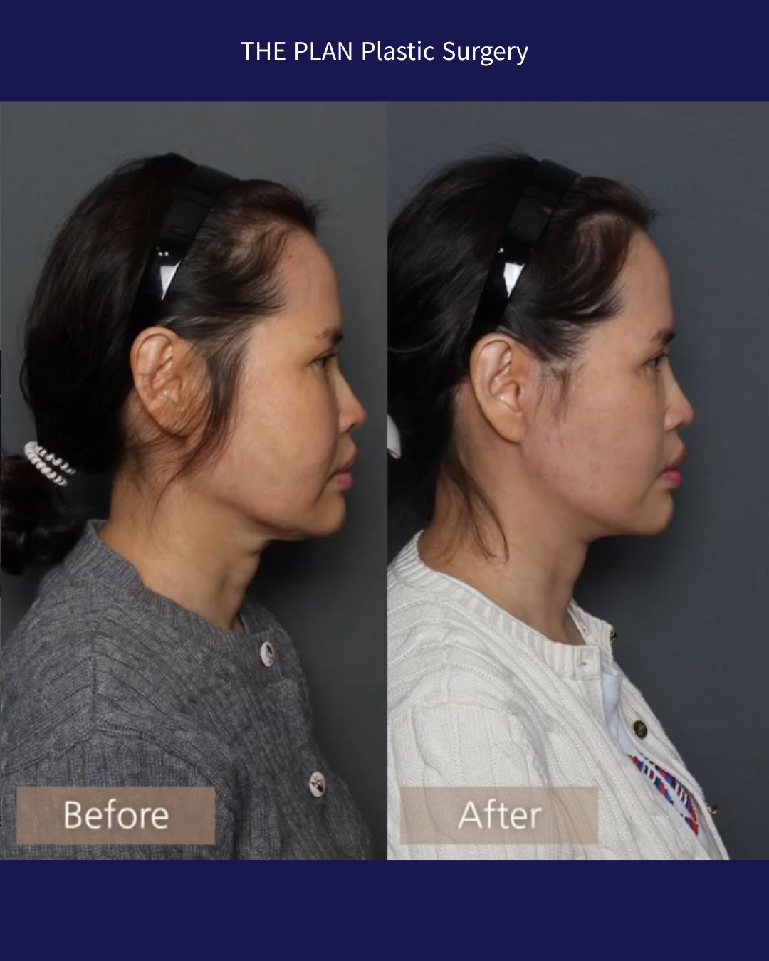 THE PLAN Plastic Surgeryの施術前と施術後の比較写真(横顔)。左側が「Before」、右側が「After」です。Beforeでは顎下や首周りにたるみが見られますが、Afterの写真では顎のラインがシャープになり、首回りがすっきりしています。また、切開リフト等による耳たぶの形の違いも側面から確認できます。