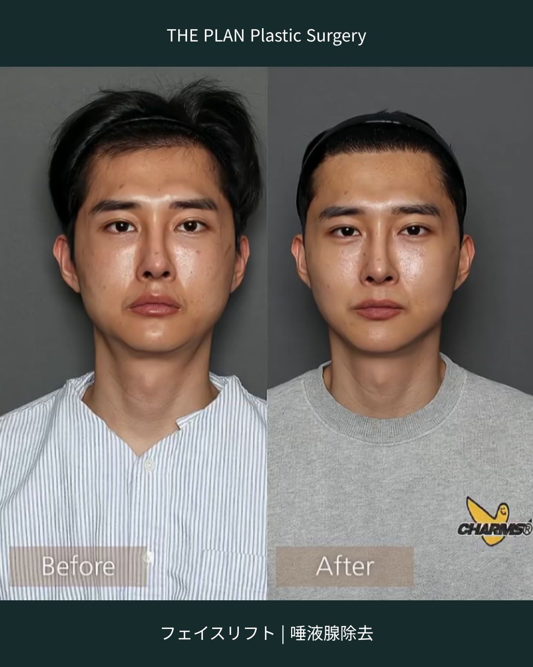 THE PLAN Plastic Surgeryのフェイスリフトと唾液腺除去の手術前後の正面比較写真。左の「Before」に比べ、右の「After」は顎のラインがシャープになり、フェイスライン全体がすっきりとした印象になっています。