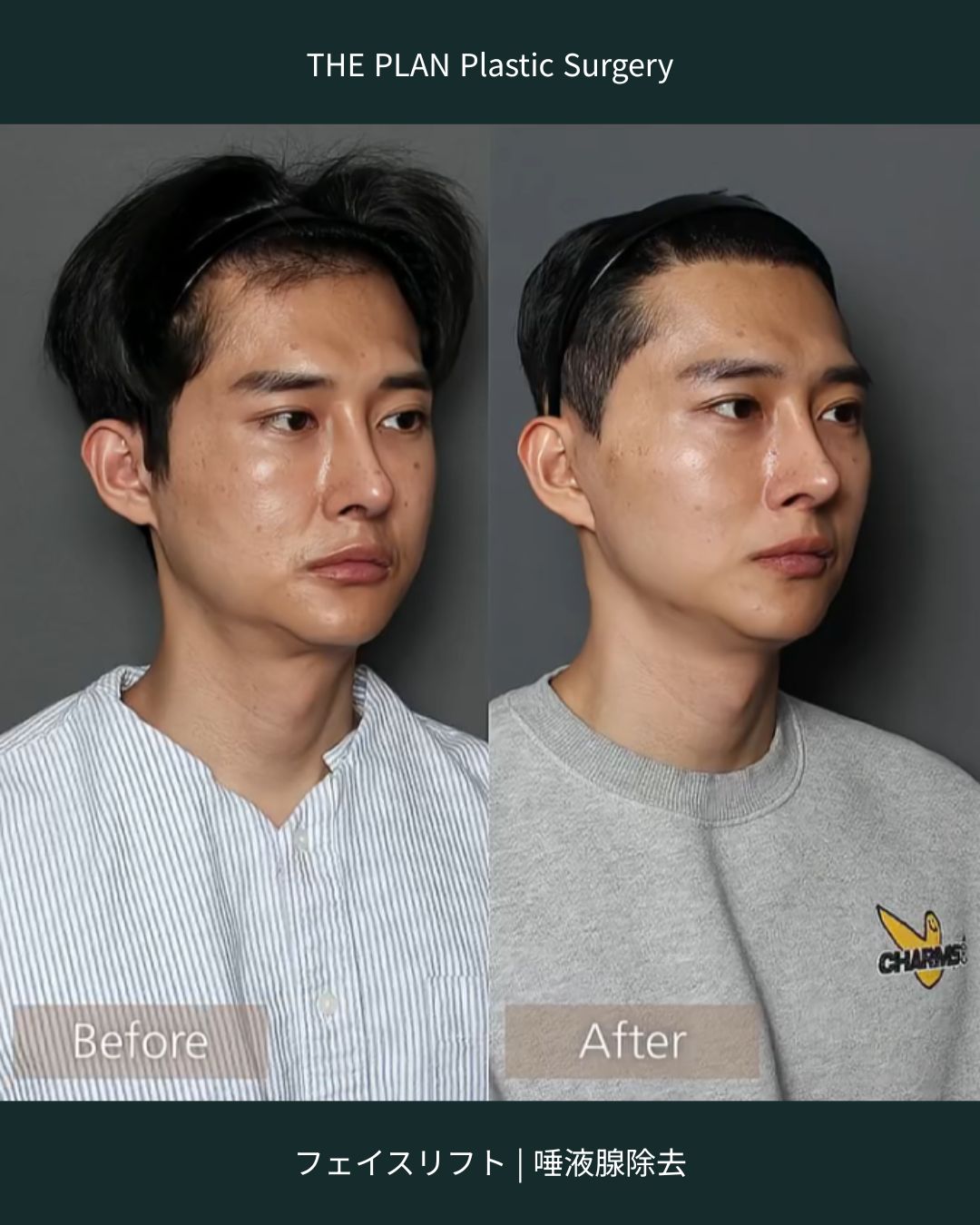 THE PLAN Plastic Surgeryのフェイスリフトと唾液腺除去の手術前後の斜め顔の比較写真。左の「Before」と比較して、右の「After」は顎下のたるみが改善され、シャープなフェイスラインに引き締まっています。