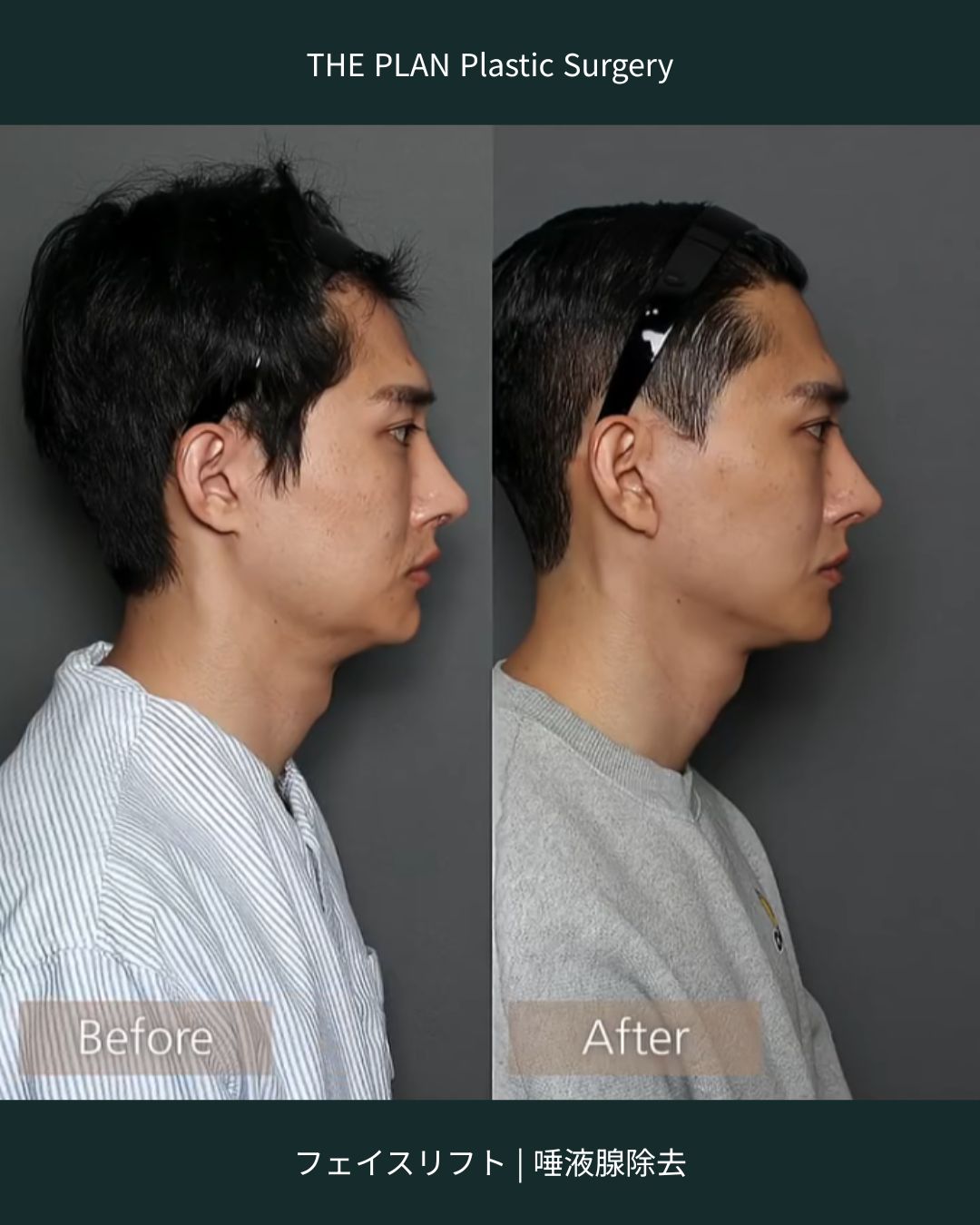 THE PLAN Plastic Surgeryのフェイスリフトと唾液腺除去の手術前後の横顔の比較写真。左の「Before」に比べ、右の「After」では耳の下から顎先にかけての輪郭がはっきりと強調され、首回りがすっきりしています。