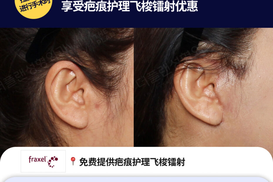 THE PLAN 整形外科全脸拉皮手术宣传海报。展示了手术前后耳周疤痕恢复对比图，并列出3-4月限定活动福利：包括免费飞梭镭射（Fraxel）疤痕护理、医院附近住宿以及接送机服务。