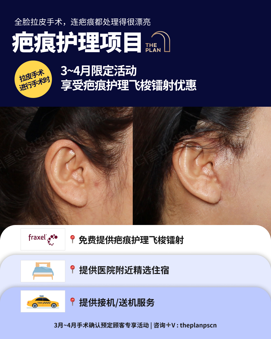 THE PLAN 整形外科全脸拉皮手术宣传海报。展示了手术前后耳周疤痕恢复对比图，并列出3-4月限定活动福利：包括免费飞梭镭射（Fraxel）疤痕护理、医院附近住宿以及接送机服务。