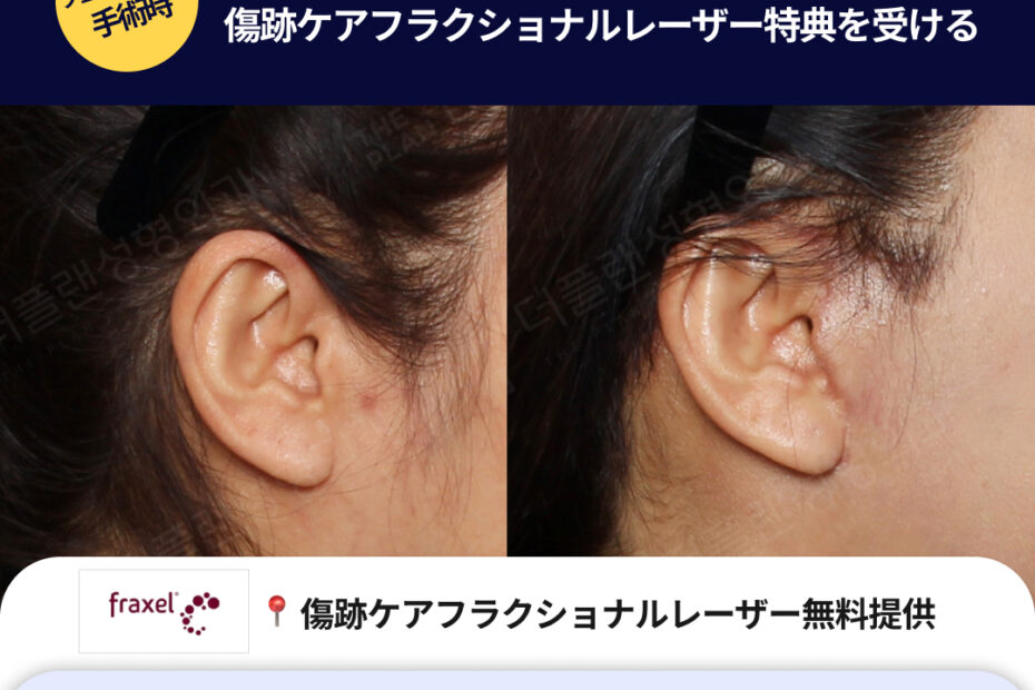 美容外科「THE PLAN」のプロモーション画像。 上部には「切開リフト、傷跡までしっかりアフターケアーが必要です。傷跡ケアプロジェクト」という大きな見出しがあります。その横に「フェイスリフト手術時」という黄色い円形のマークがあり、「3〜4月限定イベント案内 傷跡ケアフラクショナルレーザー特典を受ける」と記載されています。 中央には、切開リフト手術後の耳周辺の傷跡の経過を示す2枚の比較写真が配置されています。 下部には以下の3つの特典がアイコンと共に列挙されています。 ・Fraxel(フラクセル)のロゴと共に「傷跡ケアフラクショナルレーザー無料提供」 ・ベッドのイラストと共に「病院近隣の厳選された宿泊施設提供」 ・タクシーのイラストと共に「空港送迎サービス」 一番下の行には「3月〜4月手術確定者対象のイベント | お問い合わせ THE PLAN LINE : @theplan_psjp」と書かれています。