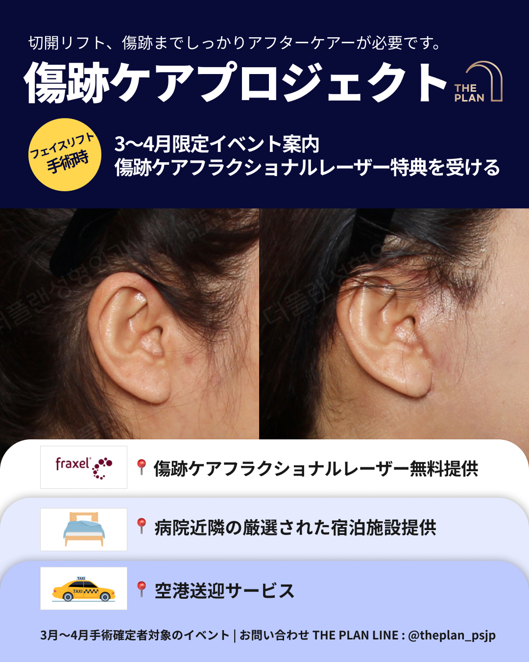 【3〜4月限定】 韓国フェイスリフト、傷跡の悩みは『フラクショナルレーザー』で解決！宿泊・送迎までフルサポート