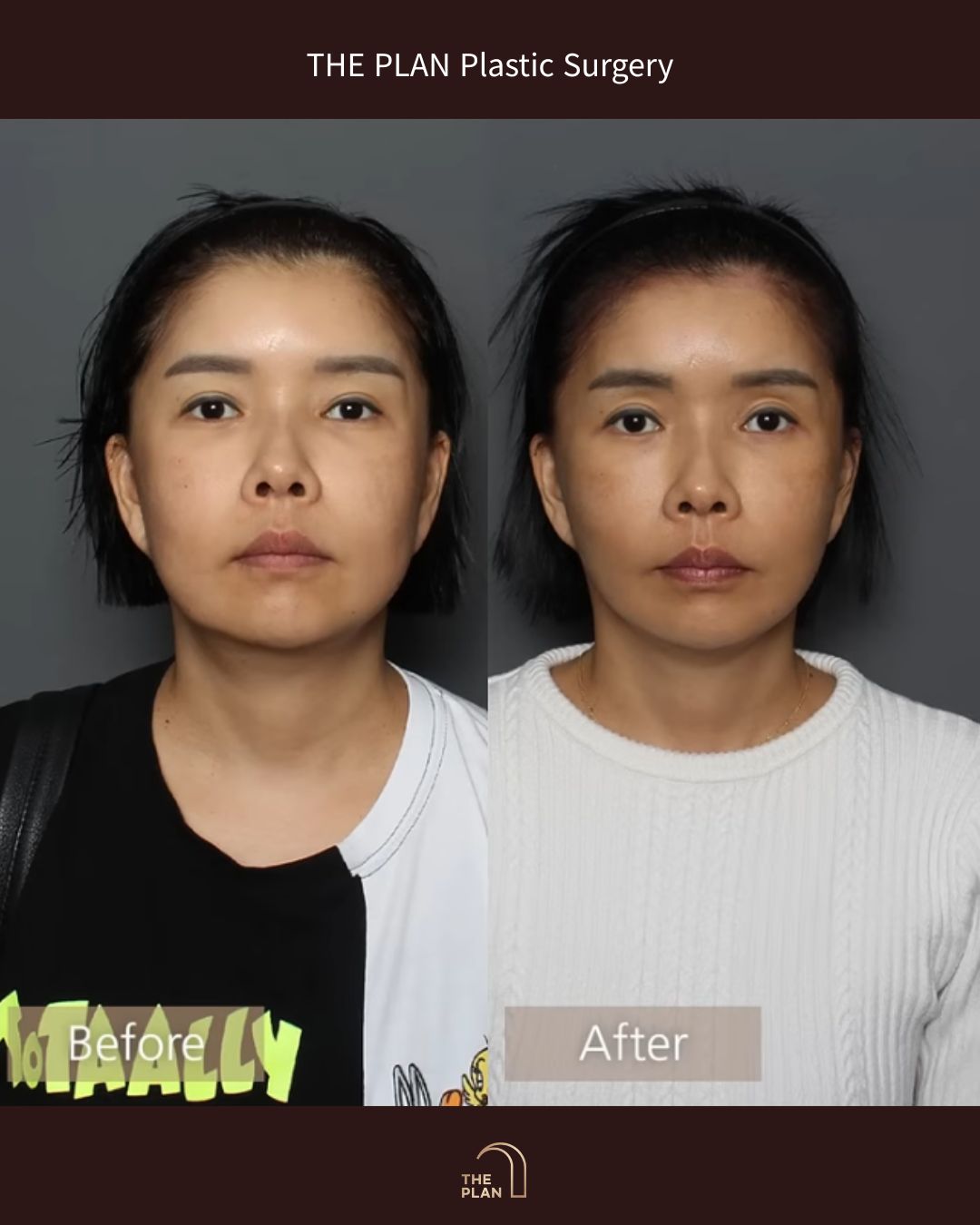 美容整形外科「THE PLAN Plastic Surgery」の施術前（Before）と施術後（After）の正面比較写真。左側の施術前と比較して、右側の施術後ではフェイスラインのたるみが改善され、すっきりと引き締まったVラインの輪郭になっています。