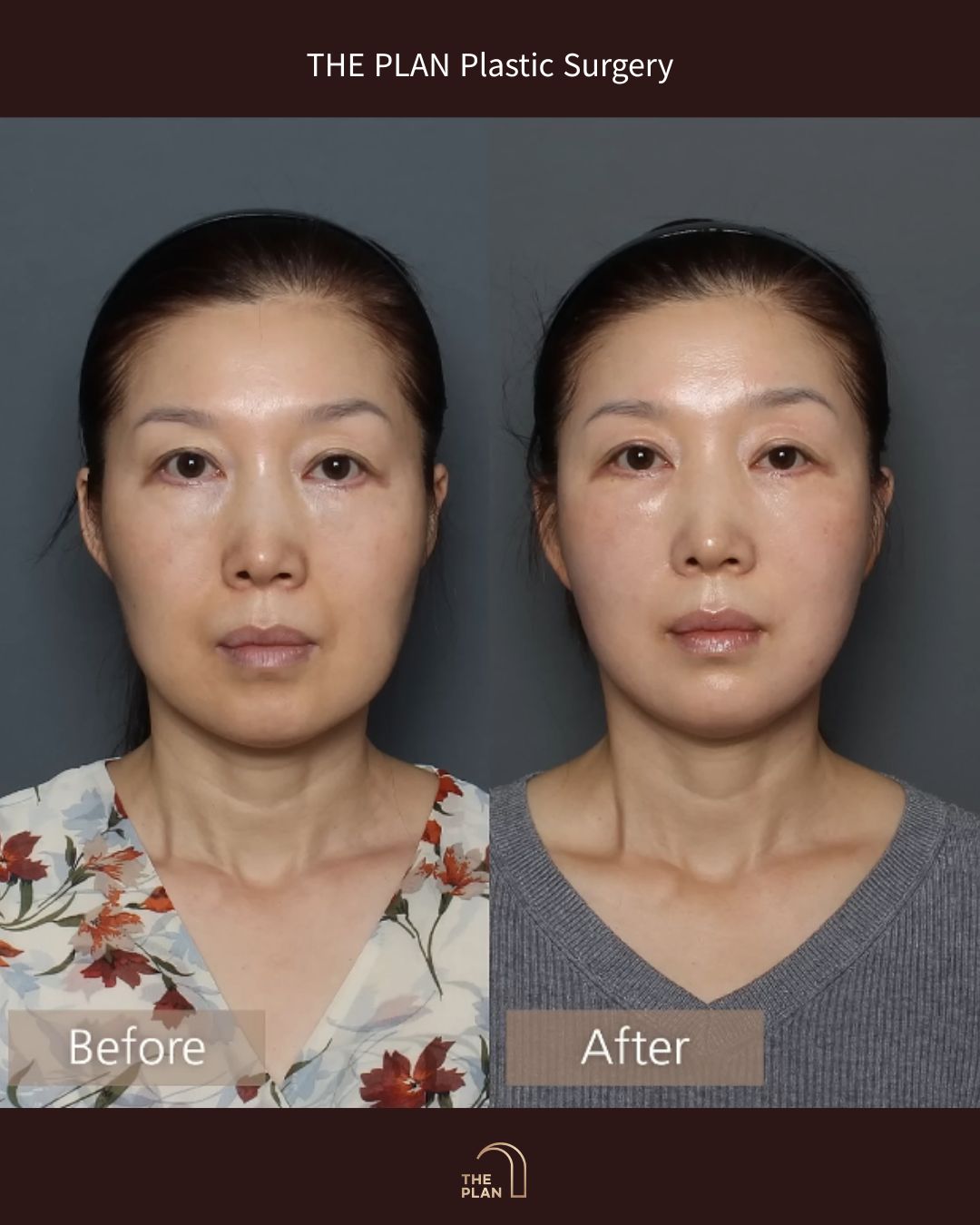 美容整形外科「THE PLAN Plastic Surgery」の施術前（Before）と施術後（After）の正面比較写真。左側の施術前と比較して、右側の施術後では顔全体のたるみが引き上げられ、くぼみや凹みのある部分にふっくらとしたボリュームが加わり、若々しくハリのある印象に改善されています。