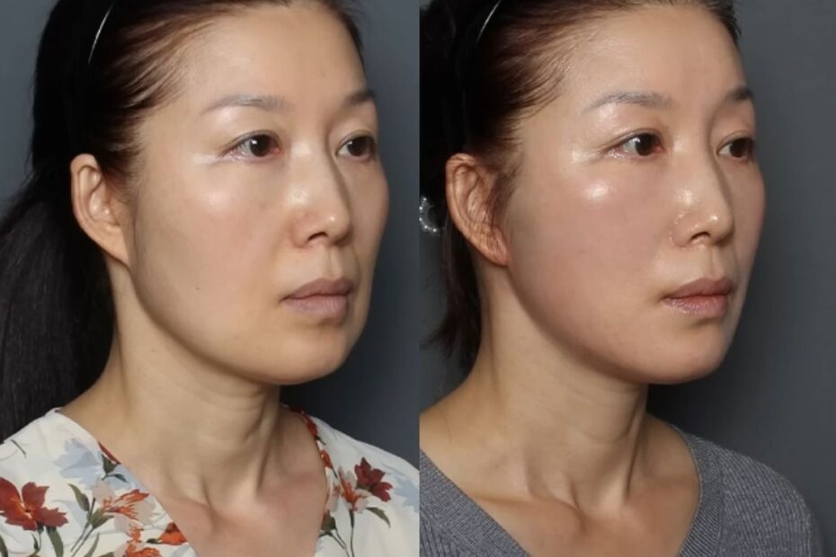 Before and after photos of a woman showing facial contour changes after plastic surgery; left panel is before, right panel is after, with a smoother jawline and refined cheek area.