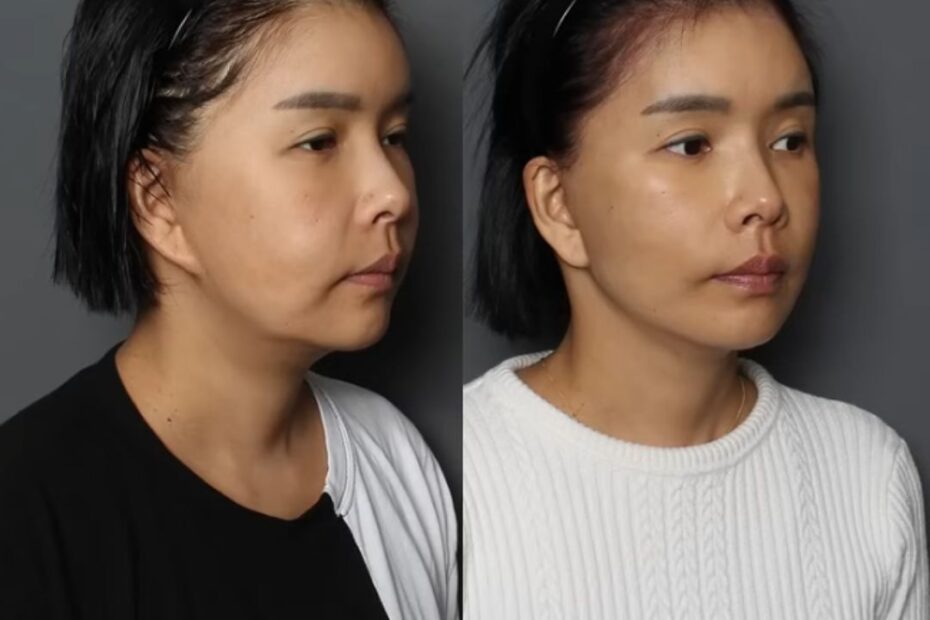 Side-by-side before-and-after photos of a woman's face from THE PLAN Plastic Surgery, showing improved jawline and smoother contour (left: before, right: after).