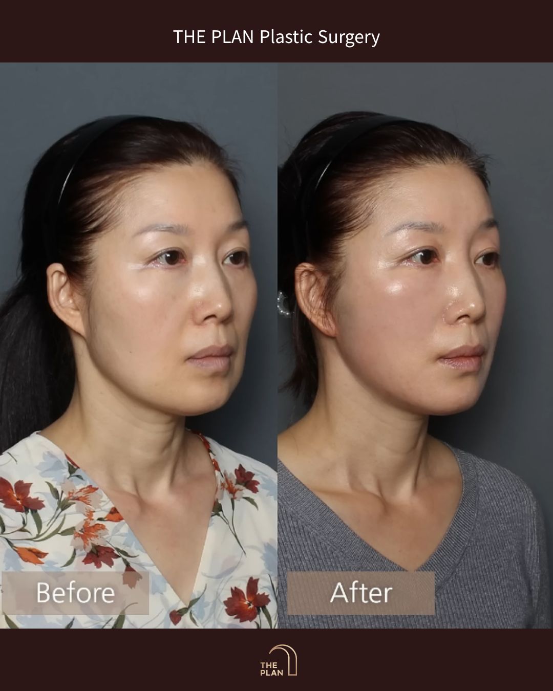 美容整形外科「THE PLAN Plastic Surgery」の施術前(Before)と施術後(After)の斜め横顔の比較写真。左側の施術前と比較して、右側の施術後ではフェイスラインのたるみがすっきりと引き締まり、頬のコケが改善されて立体的で滑らかな輪郭になっています。