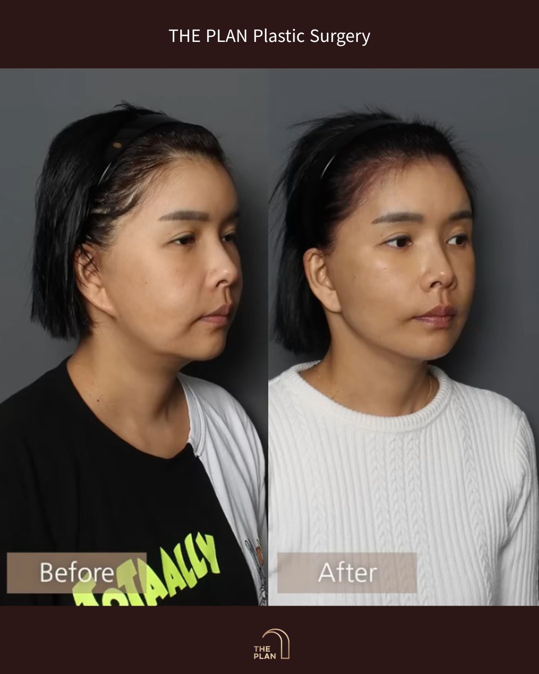 美容整形外科「THE PLAN Plastic Surgery」の施術前(Before)と施術後(After)の斜め横顔の比較写真。左側の施術前と比較して、右側の施術後では顎下から首周りにかけてのラインがシャープになり、全体的にリフトアップされた立体的な輪郭になっています。