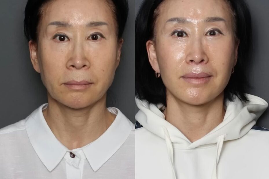 美容整形外科「THE PLAN Plastic Surgery」の施術前（Before）と施術後（After）の正面比較写真。左側の施術前と比較して、右側の施術後ではほうれい線や口周りのたるみが改善され、下顔面のバランスが整って若々しい印象になっています。