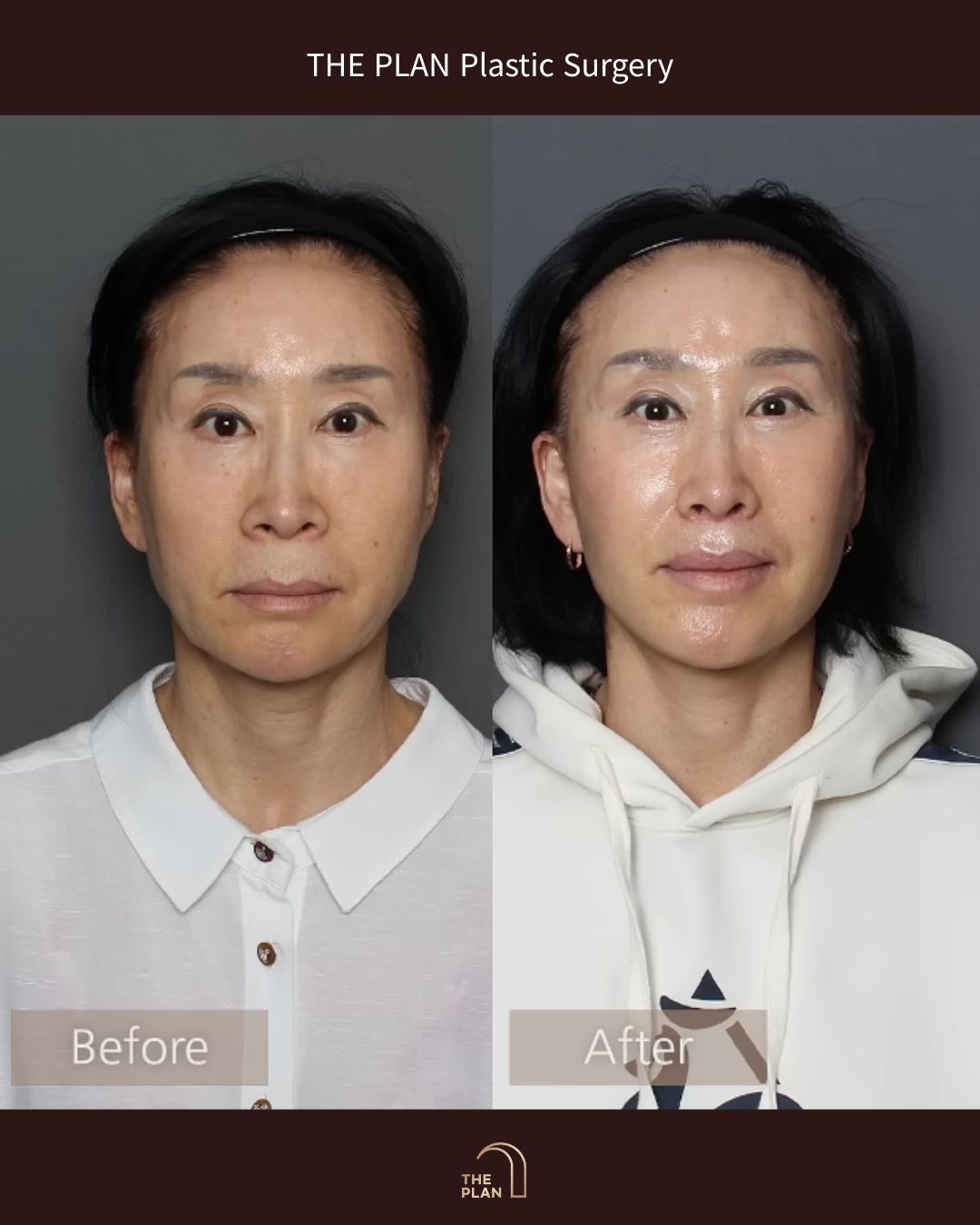 美容整形外科「THE PLAN Plastic Surgery」の施術前（Before）と施術後（After）の正面比較写真。左側の施術前と比較して、右側の施術後ではほうれい線や口周りのたるみが改善され、下顔面のバランスが整って若々しい印象になっています。