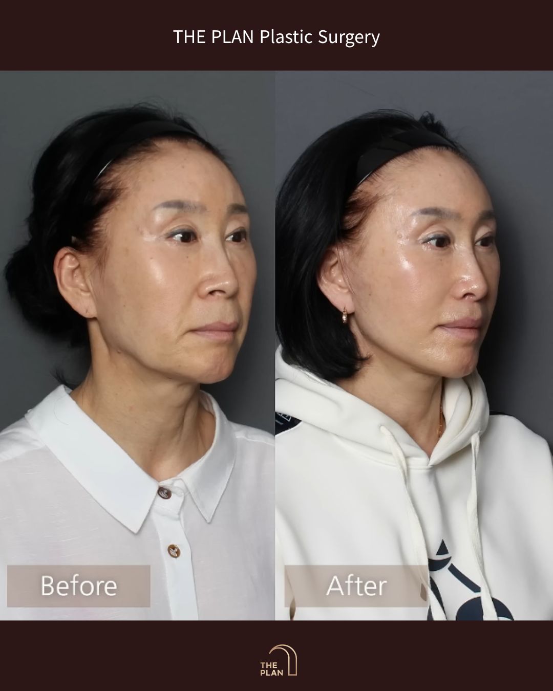美容整形外科「THE PLAN Plastic Surgery」の施術前(Before)と施術後(After)の斜め横顔の比較写真。左側の施術前と比較して、右側の施術後では顎から首にかけてのたるみがすっきりと引き上げられ、立体的で滑らかなフェイスラインに改善されています。