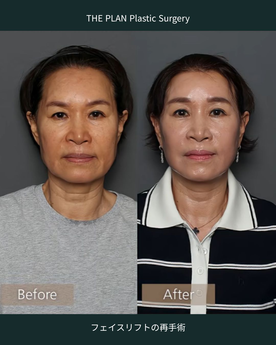 60代女性のフェイスリフト再手術および額縮小リフトのビフォーアフター。正面の比較画像。術前は頬のたるみや深いほうれい線、マリオネットラインが目立つが、術後はフェイスラインがシャープに整い、肌にハリが出て全体的に若々しい印象になっている。